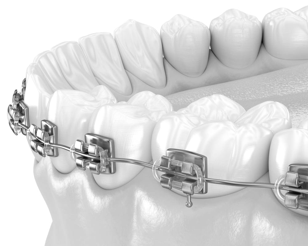 Traditional Metal Braces at Lo Elliott Orthodontics