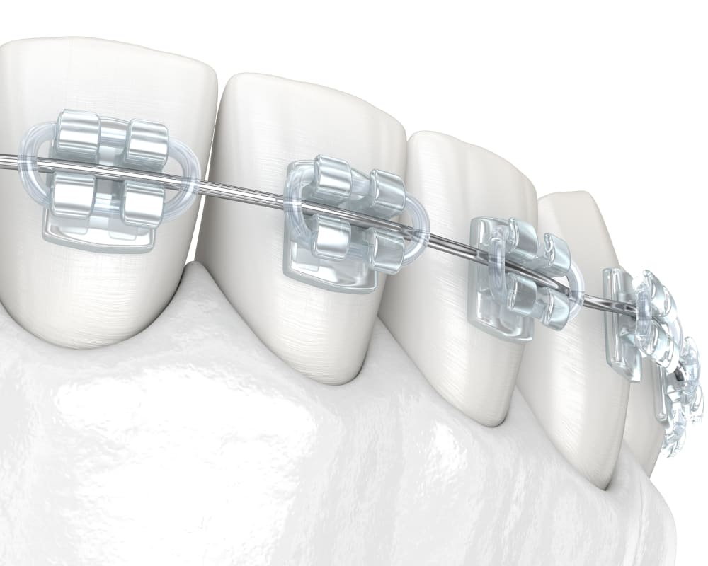 Translucent Braces at Lo Elliott Orthodontics