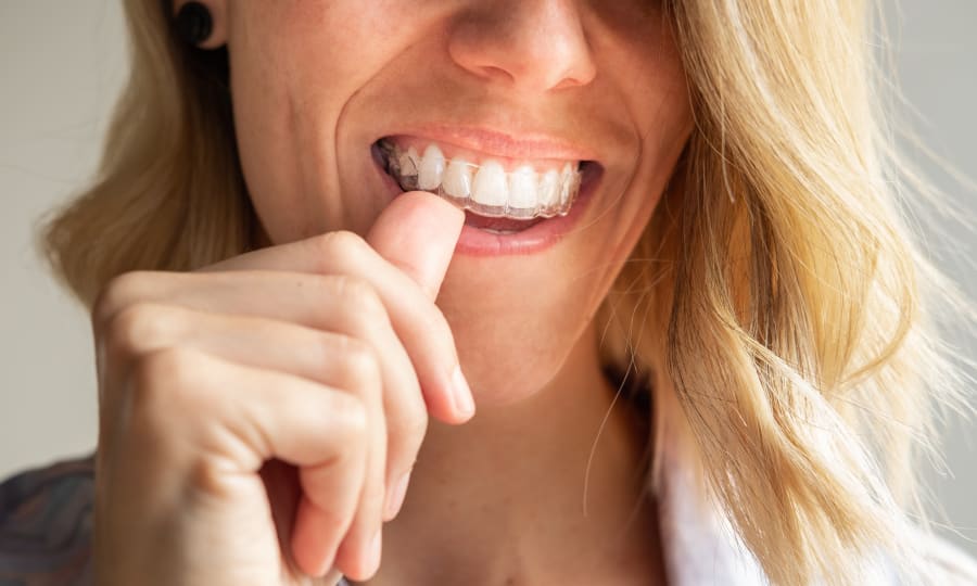 Discreet Clear Aligners at Lo Elliott Orthodontics