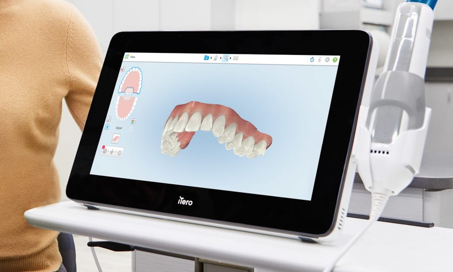 iTero Impressions at Lo Elliott Orthodontics
