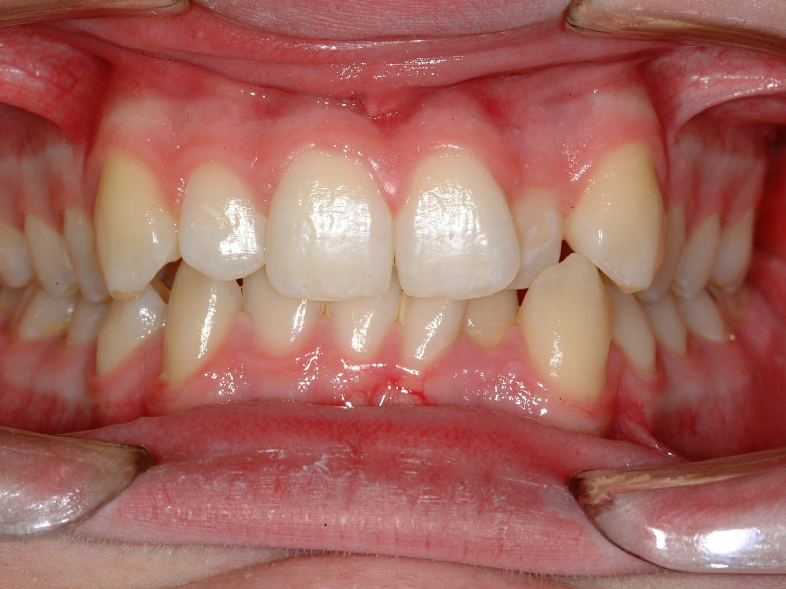 Before